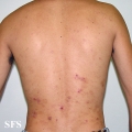 eosinophilic pustular folliculitis