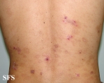 eosinophilic pustular folliculitis