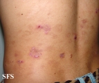eosinophilic pustular folliculitis