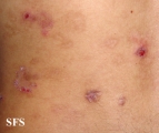 eosinophilic pustular folliculitis