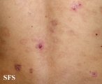 eosinophilic pustular folliculitis