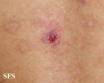 eosinophilic pustular folliculitis