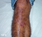 eosinophilic pustular folliculitis