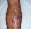eosinophilic pustular folliculitis