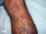 eosinophilic pustular folliculitis