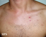 eosinophilic pustular folliculitis