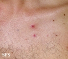 eosinophilic pustular folliculitis