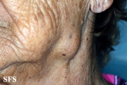 adenocarcinoma-in the submandibular salivary glands