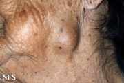 adenocarcinoma-in the submandibular salivary glands