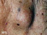 adenocarcinoma-in the submandibular salivary glands