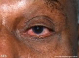 rosacea-opthalmic rosacea