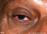rosacea-opthalmic rosacea