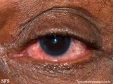 rosacea-opthalmic rosacea