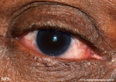rosacea-opthalmic rosacea