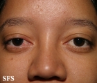 rosacea-opthalmic rosacea