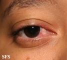 rosacea-opthalmic rosacea