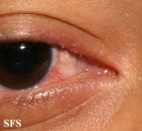 rosacea-opthalmic rosacea