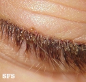 pediculosis palpebrarum