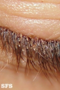 pediculosis palpebrarum
