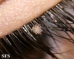 pediculosis palpebrarum