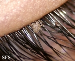 pediculosis palpebrarum