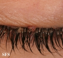 pediculosis palpebrarum