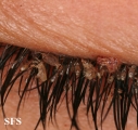 pediculosis palpebrarum
