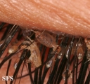 pediculosis palpebrarum