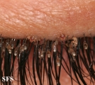 pediculosis palpebrarum