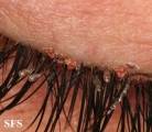 pediculosis palpebrarum
