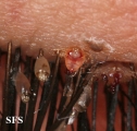 pediculosis palpebrarum