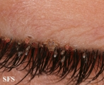 pediculosis palpebrarum