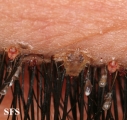 pediculosis palpebrarum