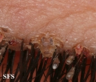 pediculosis palpebrarum