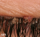 pediculosis palpebrarum