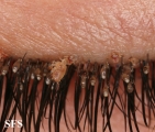 pediculosis palpebrarum
