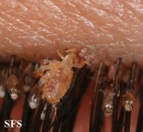 pediculosis palpebrarum