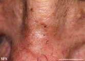 actinic_keratosis-atrophic_actinic_keratosis