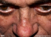 actinic_keratosis-atrophic_actinic_keratosis