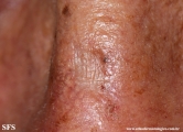 actinic_keratosis-atrophic_actinic_keratosis