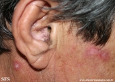 lupus erythematosus chronicus discoides