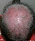 lupus erythematosus chronicus discoides