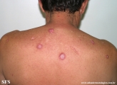 lupus erythematosus chronicus discoides