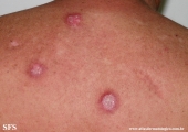 lupus erythematosus chronicus discoides