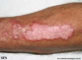 lupus erythematosus chronicus discoides