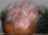 lupus erythematosus chronicus discoides