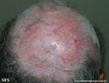 lupus erythematosus chronicus discoides