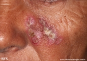 lupus erythematosus chronicus discoides