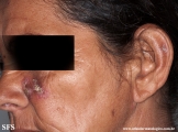 lupus erythematosus chronicus discoides