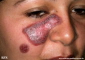 lupus erythematosus chronicus discoides